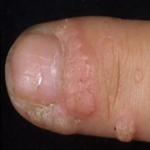 brodawka przy paznokciu