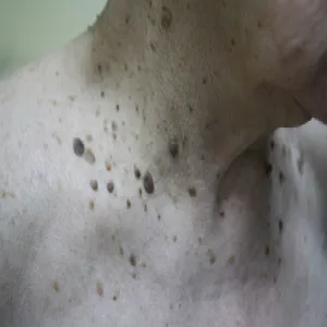 brodawki łojotokowe na szyi