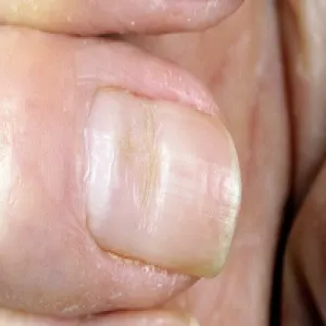 bruzdy na paznokciu zdjęcie