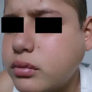 choroba świnka objawy u dzieci