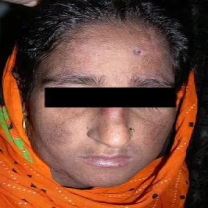 choroba genetyczna u człowieka genodermatoza 