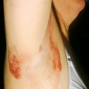 choroba haileya-haileya zdjęcia