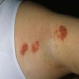 Choroba Haileya-Haileya