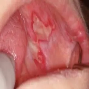 choroby jamy ustnej zdjęcia liszaj czerwony