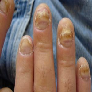 choroby paznokci pachyonychia 