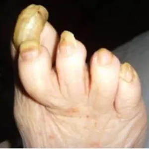 choroby paznokci u nóg zdjęcia