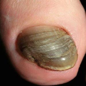 choroby paznokcia dużego palca