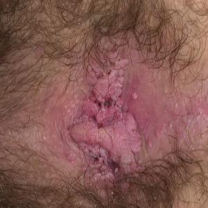 choroby warg sromowych zdjęcia grudkowatość bowenoidalna 