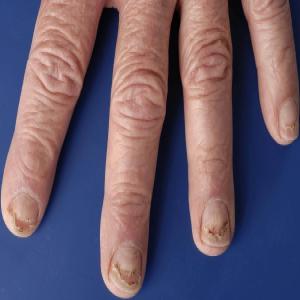 choroby widoczne na paznokciach linie beau 