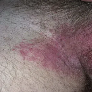 czerwone swędzące plamy w okolicach krocza