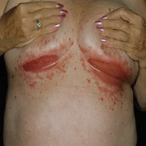 czerwone zmiany skórne pod piersiami odparzenia