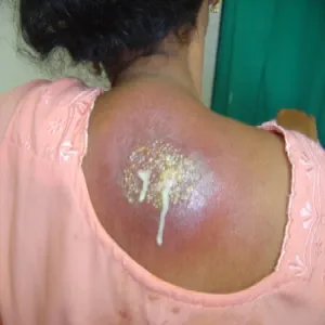 czyrak ropny na plecach