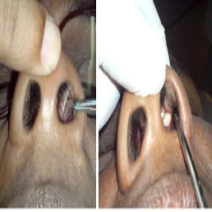 czyrak w nosie jak wygląda