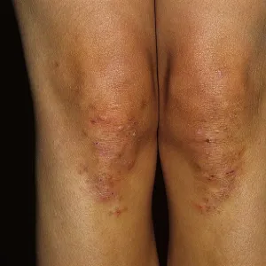 dermatitis herpetiformis DH