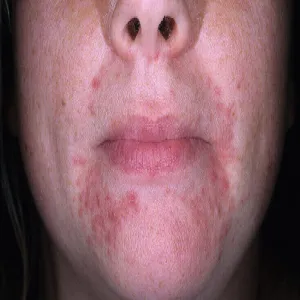 dermatoza okołoustna