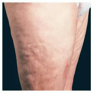 diffuse fascitis with eosinophilia 