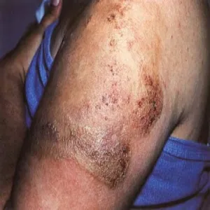 eosinophilic cellulitis 