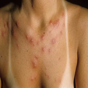 fotodermatoza uczulenie na słońce