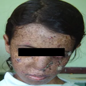 genodermatoza 