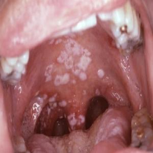 grzybica jamy ustnej po antybiotykach
