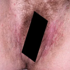 grzybica pachwin u kobiet