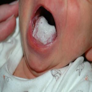 grzybica w jamie ustnej u dzieci