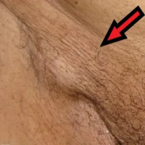 guz w okolicach pachwiny