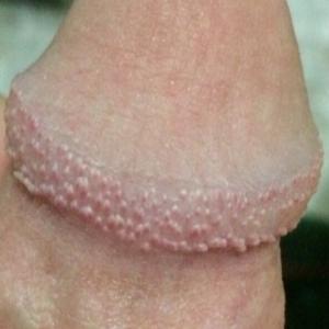 hirsutoid papillomas of the penis