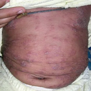 jak wygląda świerzb u dzieci 