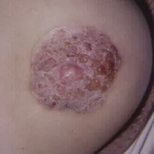 jak wygląda rak sutka zdjęcia