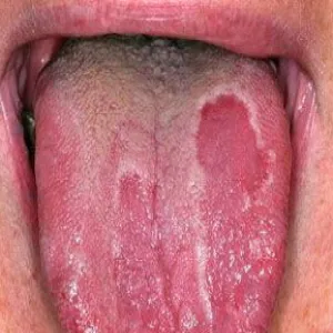 Język z jasnoróżowymi plamami z białą obwódką