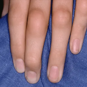 juvenile idiopathic arthritis 