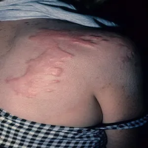  keloid