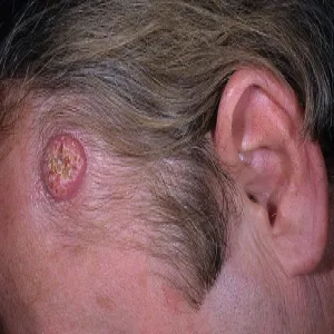 keratoacanthoma zdjęcie