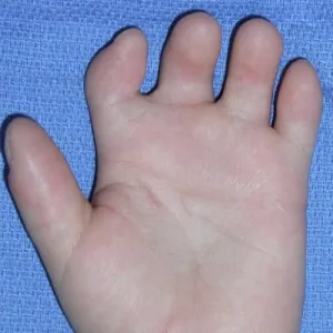 krótkie palce brachydaktylia