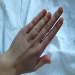 krótkopalczastość