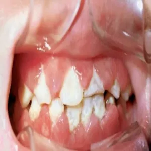 krętkowe zapalenie dziąseł