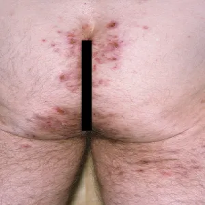 Krosty na pośladkach opryszczkowate zapalenie skóry