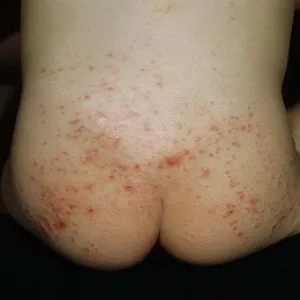 krosty na pośladkach u dziecka świerzb