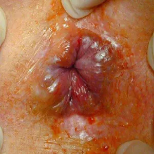 krwawienia z odbytu po oddaniu stolca