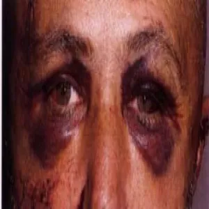 Krwiak okularowy zdjęcie