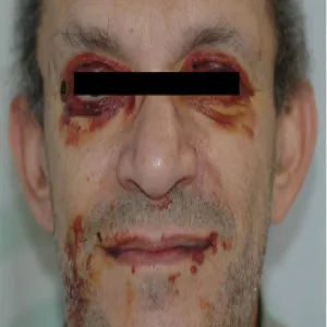 krwiaki okularowe towarzyszące złamaniu podstawy 