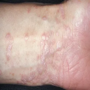 lichen planus