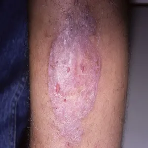 liszaj płaski barwnikowy