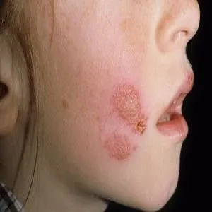 liszajec zakaźny u dzieci na twarzy