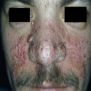 małe krostki na twarzy u dorosłych choroba gruczolak łojowy