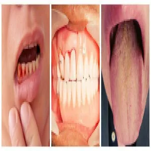 martwiczo-wrzodziejące zapalenie dziąseł objawy