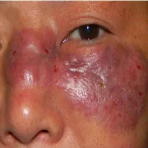 mukormykoza objawy skórne