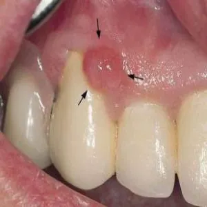 nadziąślak jak wygląda