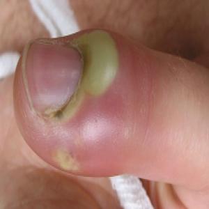 obrzęk wału paznokciowego